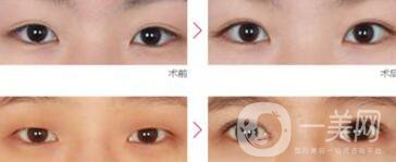 如果開(kāi)眼角失敗該怎么辦