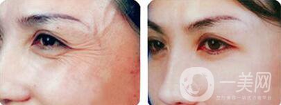 *注射去皺大概幾天見(jiàn)*