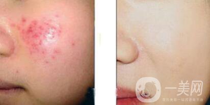 果酸換膚的副作用？果酸換膚幾天恢復(fù)？