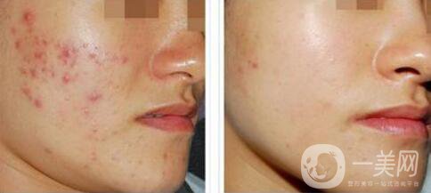 果酸換膚的副作用？果酸換膚幾天恢復(fù)？