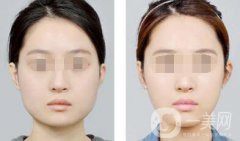 南京注射注射瘦臉*價格是多少