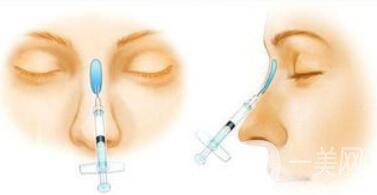 武漢注射隆鼻失敗修復(fù)價(jià)格多少