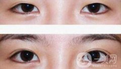 在濟南割雙眼皮費用是多少