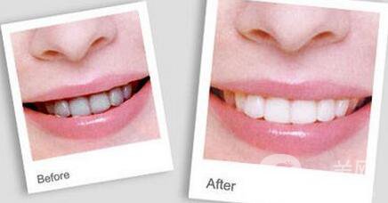 洗牙后具體注意事項(xiàng)有哪些