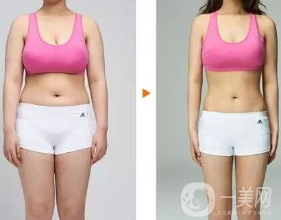 鐳射溶脂價(jià)格要多少錢？