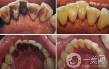 *潔牙好不好？*果可以維持幾年？