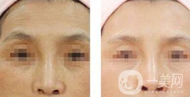 除皺注射雙美膠原蛋白多少錢一支