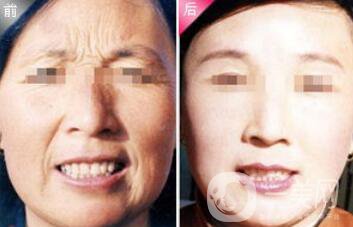 除皺注射雙美膠原蛋白多少錢一支