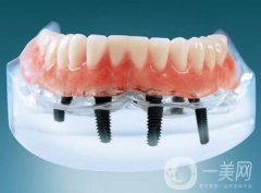 種植牙可以用多久？維持時間