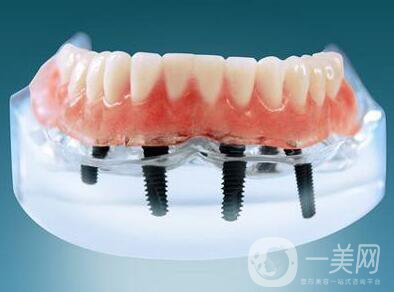 種植牙可以用多久？維持時(shí)間