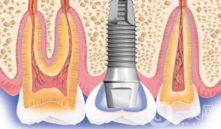 種植牙可以用多久？維持時(shí)間