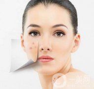 復(fù)合彩光祛痘印多久一次？