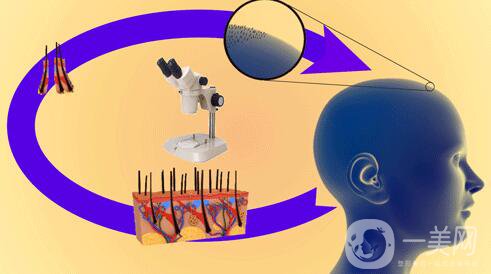 fut植發(fā)技術(shù),優(yōu)缺點