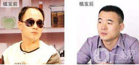 fut植發(fā)技術(shù),優(yōu)缺點