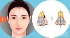 重慶歪鼻矯正一般需要多少錢 費用解析