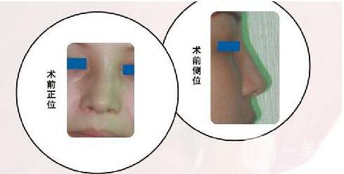 歪鼻矯正,多少錢