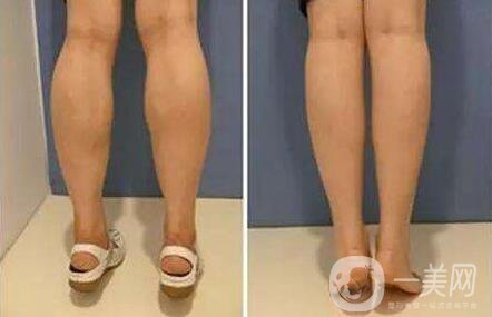 光纖溶脂瘦小腿