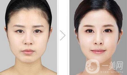 國內醫(yī)院做磨下頜角手術項目的價格介紹一覽