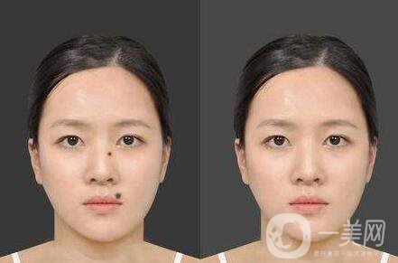 激光點(diǎn)痦子,多少錢