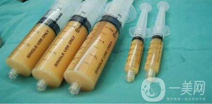 自體脂肪豐眼窩手術(shù)恢復(fù)過程介紹 術(shù)后注意一覽