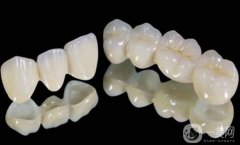 鈷鉻烤瓷牙好不好？可以保持多久？