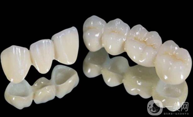 鈷鉻烤瓷牙好不好？可以保持多久？