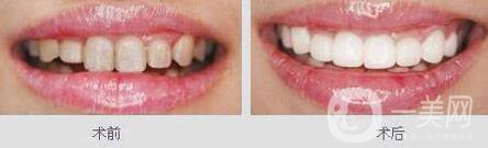 鈷鉻烤瓷牙好不好？可以保持多久？