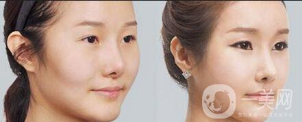 做一次磨顴骨手術(shù)前后一共大概需要多少錢