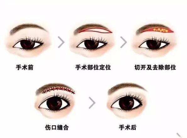 上海眉整形大概需要多少錢？