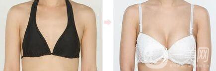 美國(guó)麥格假體隆胸怎么樣？麥格假體多少錢？