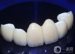 貴金屬烤瓷牙和全瓷牙信息介紹？