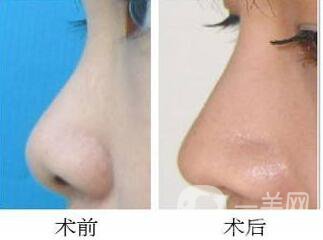 膨體隆鼻,后期*果