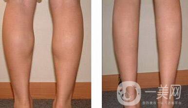 *瘦小腿反彈嗎？