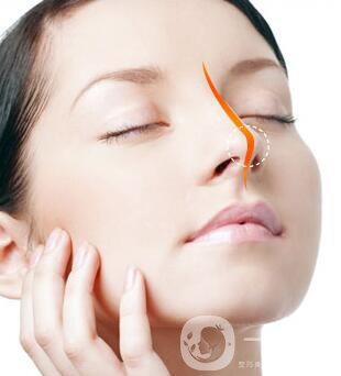 硅膠墊鼻梁多久生包膜？如何避免隆鼻后遺癥？