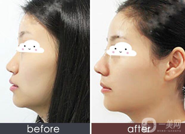 硅膠墊鼻梁多久生包膜？如何避免隆鼻后遺癥？