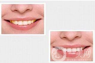 貴金屬烤瓷牙,種類,優(yōu)點