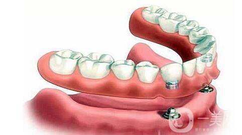 昆山種植牙價(jià)格一般是多少錢