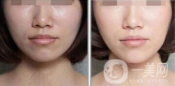 激光嫩膚*果怎么樣?明星擁有白皙肌膚的秘密