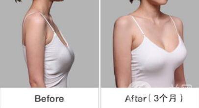 乳房下垂松軟怎么辦？可以做手術(shù)矯正嗎？