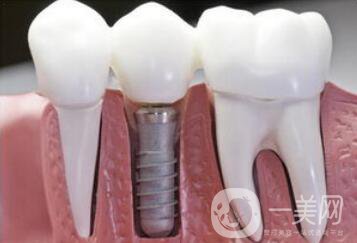 在寧波做人工種植牙一顆價格是多少