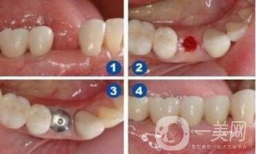 在寧波做人工種植牙一顆價格是多少