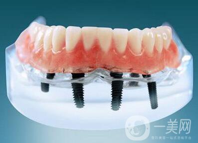 上海九院種植牙價(jià)格要多少錢？