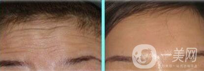 激光去抬頭紋怎么樣、*果*嗎