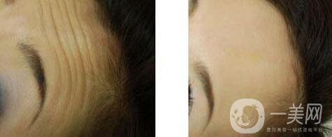 激光去抬頭紋怎么樣、*果*嗎