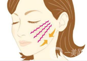 北京醫(yī)院做面部提升一次價格一般是多少