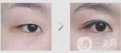 不開刀的雙眼皮果是*的嗎