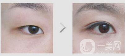 不開(kāi)刀的雙眼皮*果是*的嗎