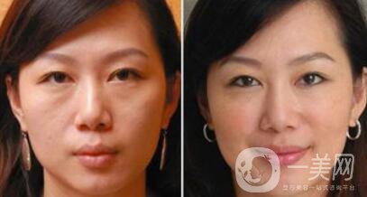 塑美極*果怎么樣？塑美極要做多少次？