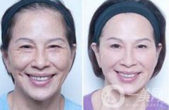 塑美極果怎么樣？塑美極要做多少次？