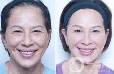 塑美極*果怎么樣？塑美極要做多少次？